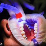wstawianie implantów stomatologicznych w krakowie